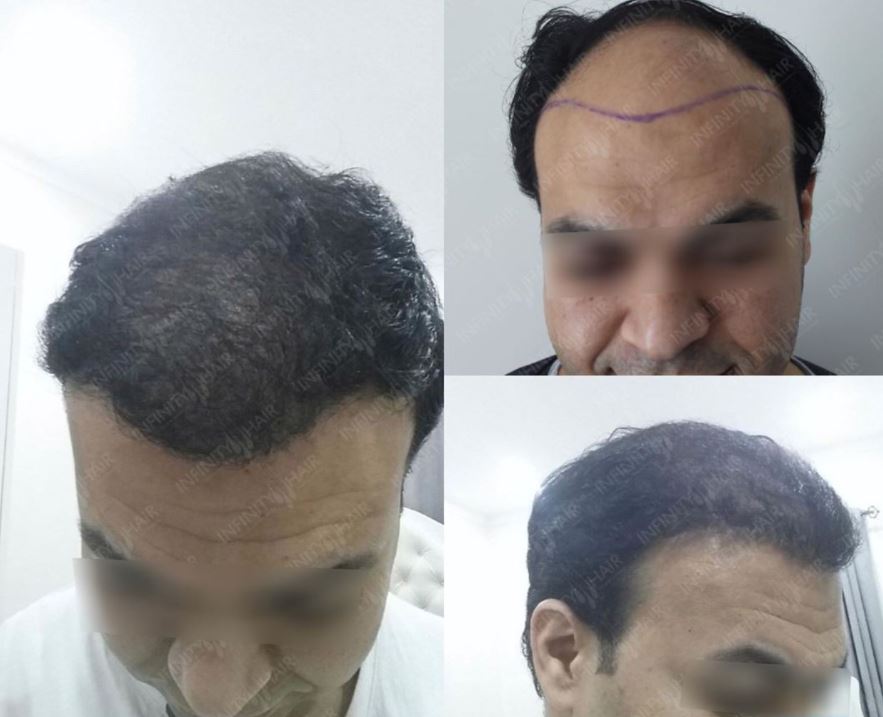 Infinity Hair Transplant Turkey before and after