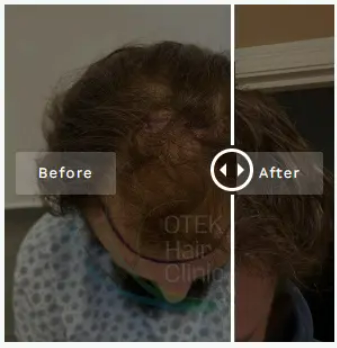 otek hair clinic before after photos