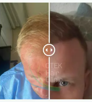 otek hair clinic before after results