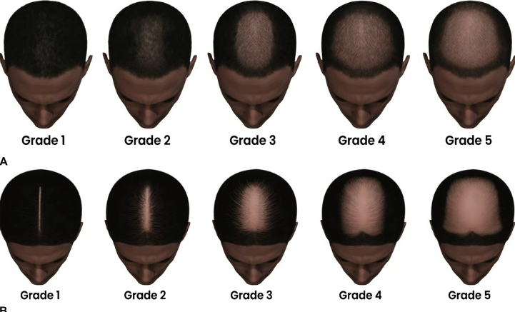 sinclair scale hair loss