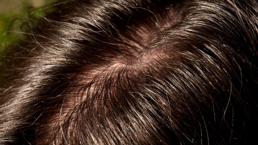 hair loss in teenagers