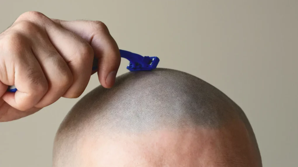 What is the hair loss sinclair scale